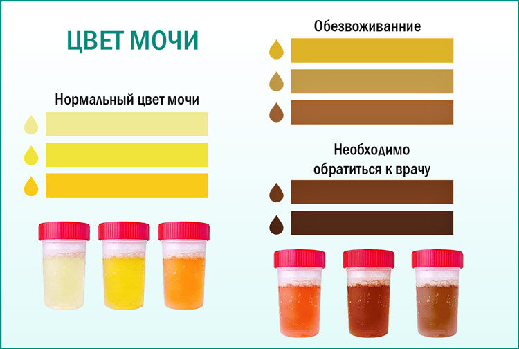 Темная, оранжевая, желтая моча у грудничка: о чем говорит оттенок