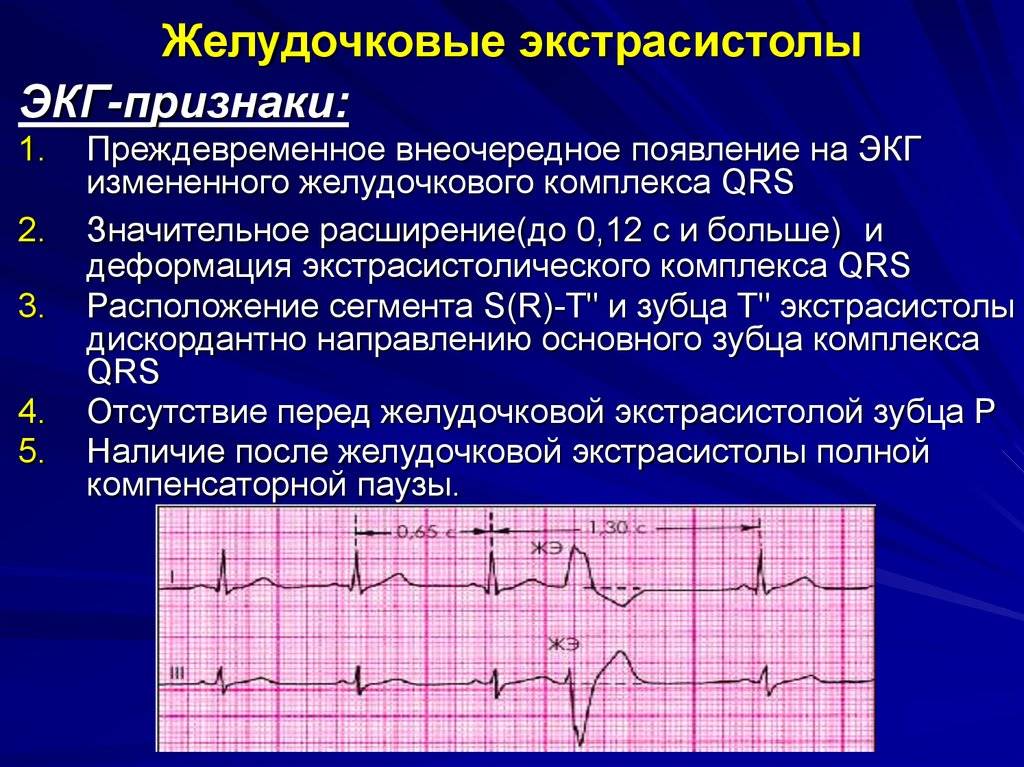 Желудочковая экстрасистолия у детей: 12 причин, 6 симптомов, лечение, осложнения, профилактика