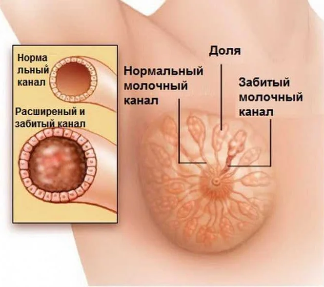 Лактостаз: симптомы и признаки; причины, профилактика, лечение