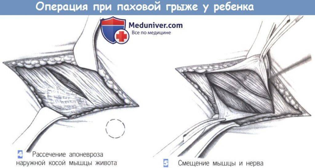Паховая грыжа у детей