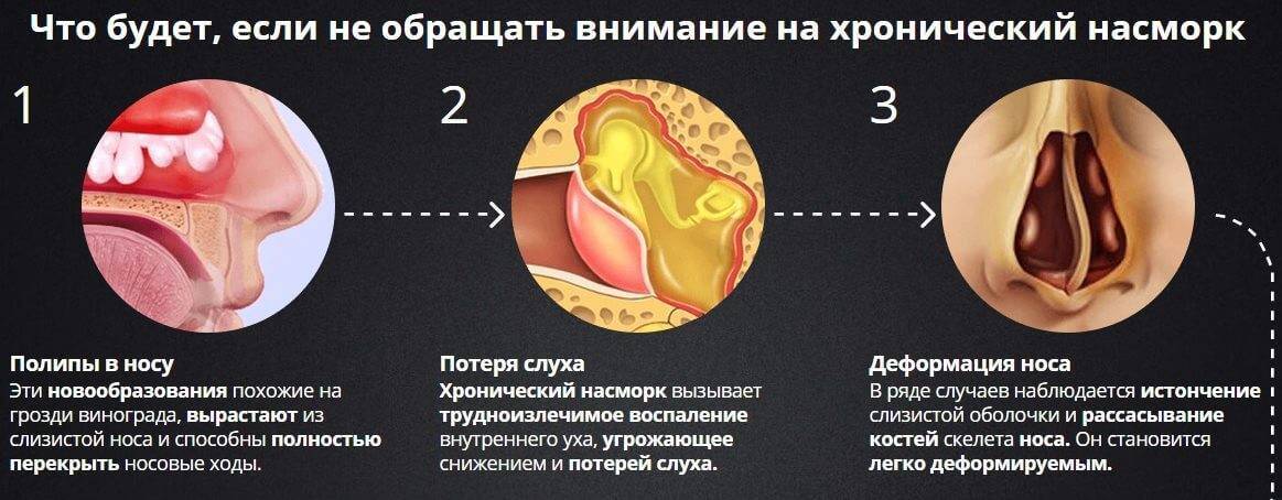 Симптомы и лечение полипов в носу у ребенка