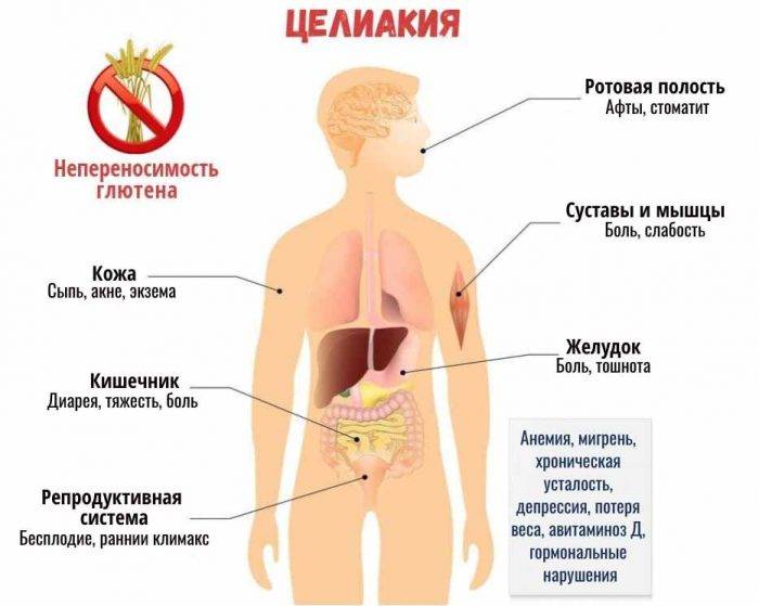 Целиакия: симптомы, причины, диагностика, лечение
