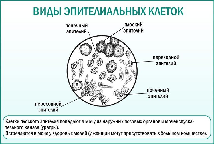 Плоский эпителий в моче у ребенка - норма, причины появления