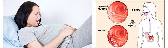 Гастрит при беременности: причины, симптомы, лечение, народные средства, диета, обострение, острый и хронический, отзывы, в 1, 2, 3 триместре, видео