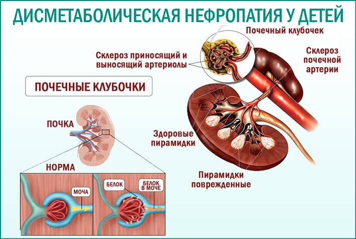 Дисметаболическая нефропатия: код по мкб 10, причины и лечение