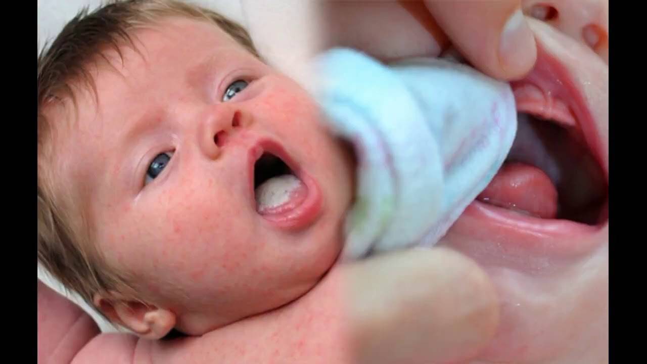 Чем обрабатывать молочницу. Кандидоз ротовой полости у младенца. Молочница во рту у грудничка.
