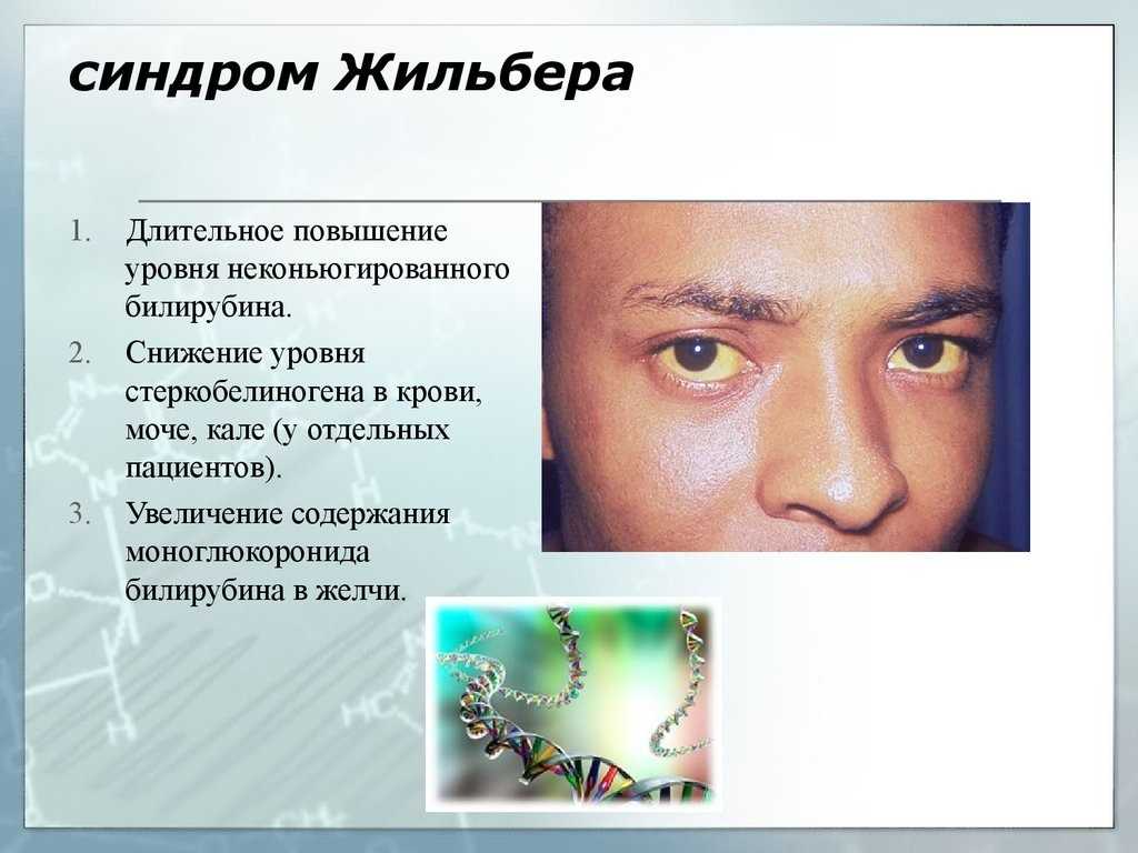 Синдром жильбера: обзор 4-х групп препаратов для лечения, а таже о причинах, симптомах и диагностике