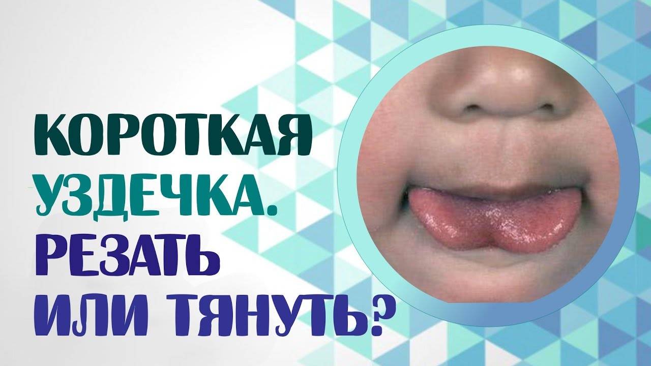 Короткая уздечка языка у ребенка: причины, признаки и методы лечения