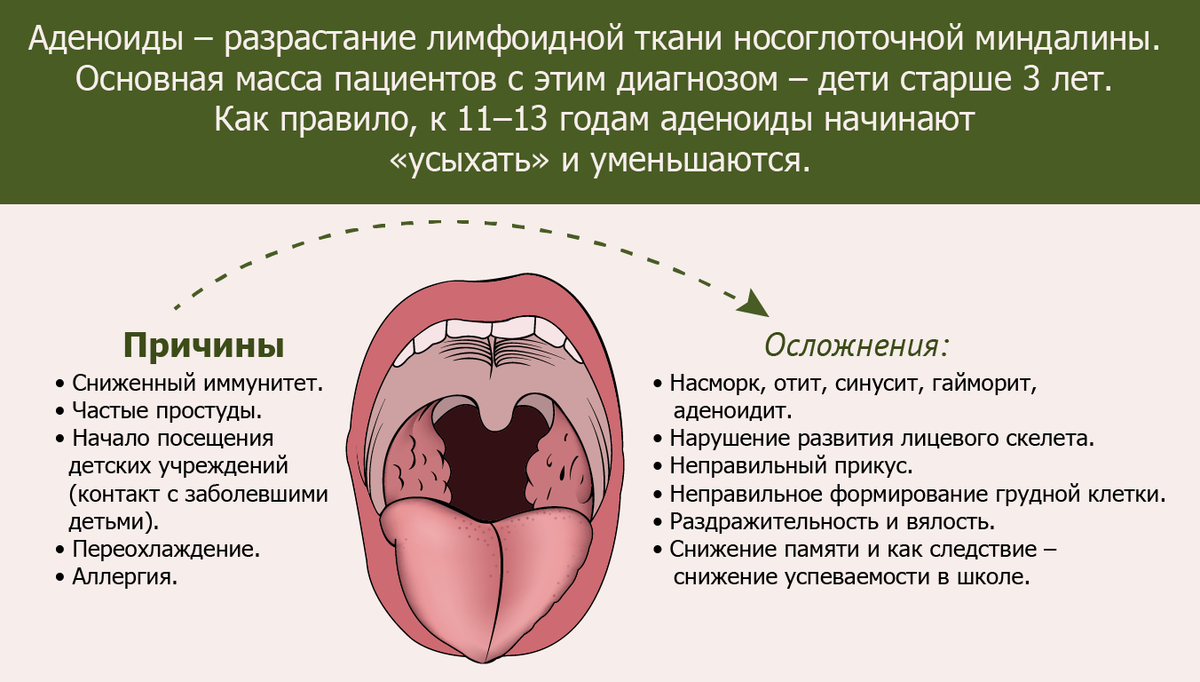 Схема лечения гнойной ангины