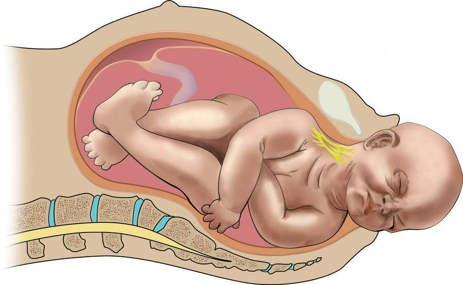 Разрыв плода. Родовая травма парез Дюшена Эрба. Паралич Дюшена Эрба у новорожденных. Дистоция плечиков плода. Парез Эрба(родовая травма) схема.