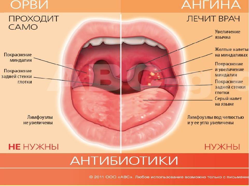 Лакунарная ангина у детей: 5 этапов лечения и советы от педиатра