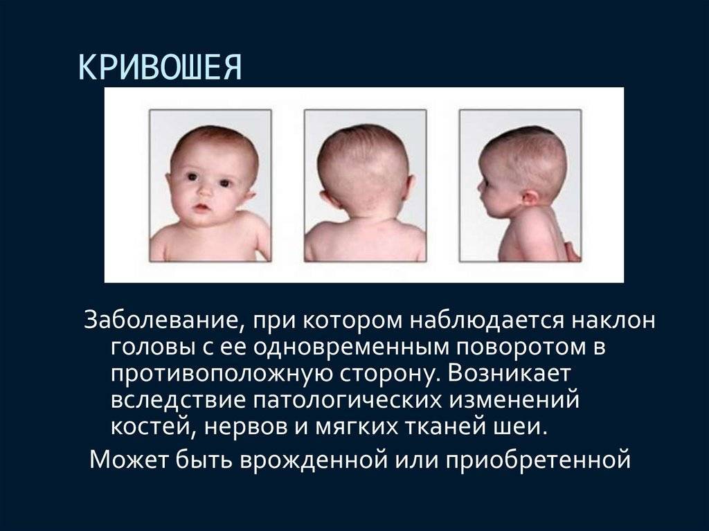 Кривошея у новорожденных детей: фото, симптомы, признаки, лечение грудничка