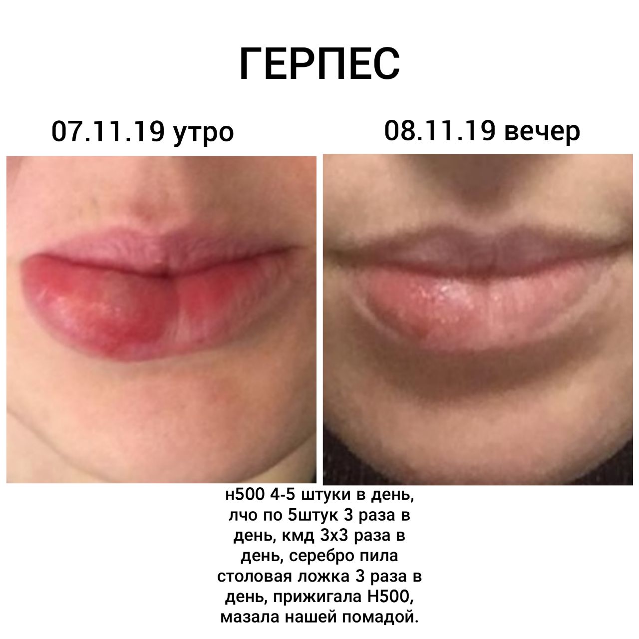 Мать с генитальным герпесом: можно ли кормить грудью