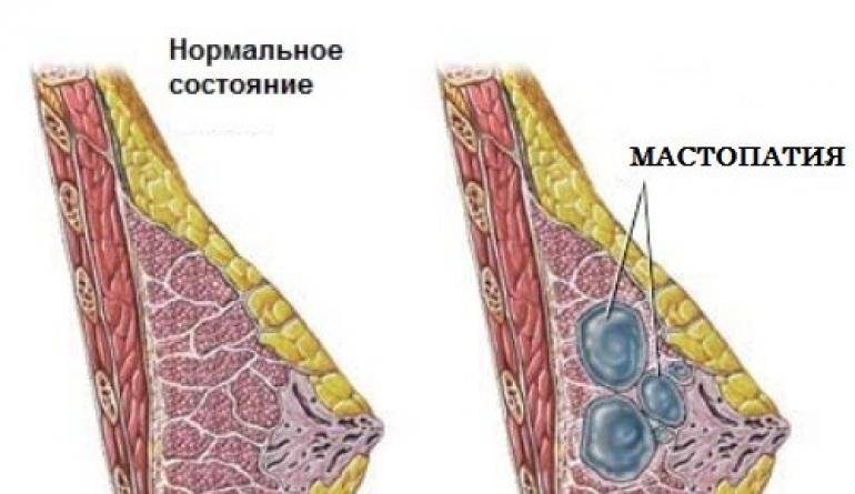 Фиброзно Кистозная Мастопатия Молочной Железы Фото