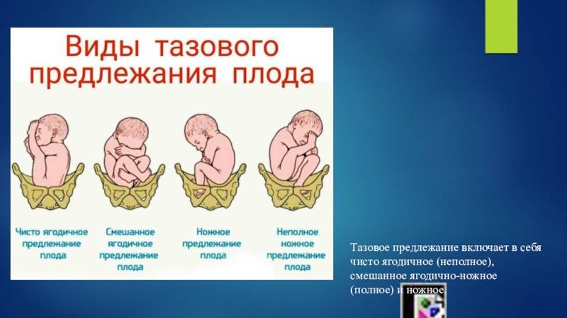 Ягодичное предлежание плода | уроки для мам