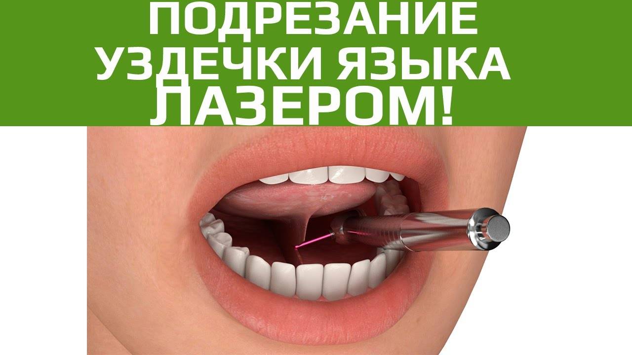 Короткая уздечка под языком у новорожденного