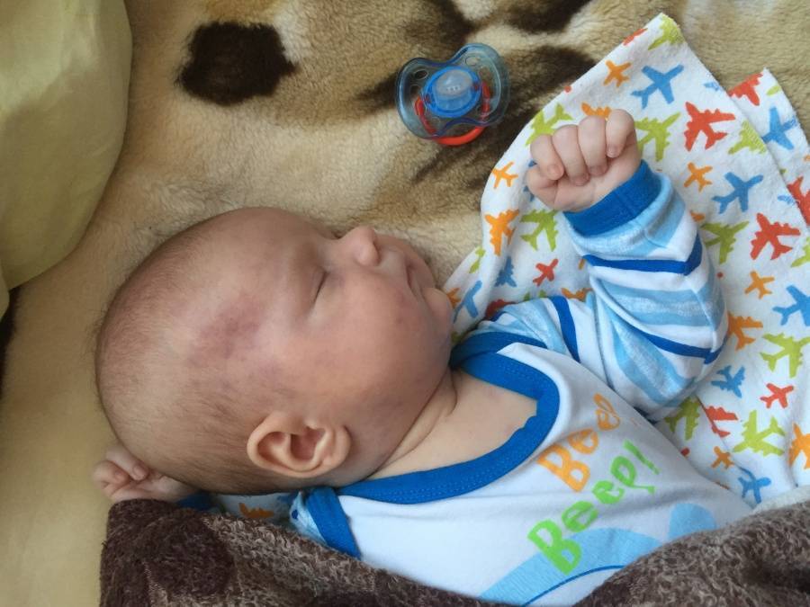 Кефалогематома у новорожденных: как лечить родовую травму и предотвратить последствия
