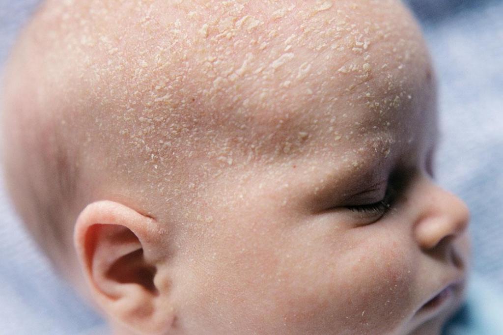 Как убрать молочные корочки с головы младенца