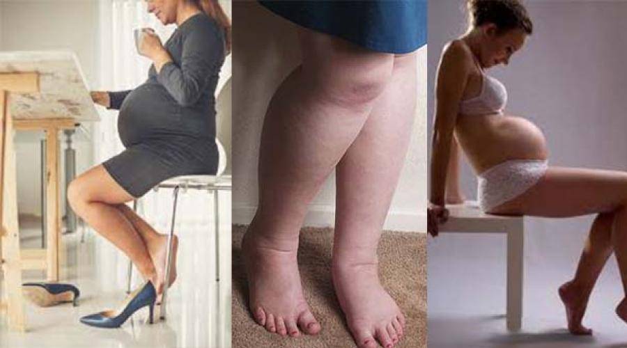 Почему у беременных отеки ног. Отекшие ноги у беременных.