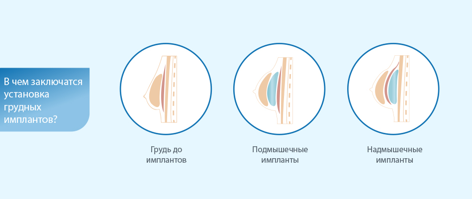 Можно ли кормить грудью с имплантами