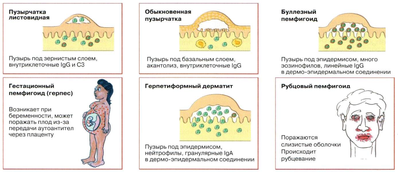 Водянистые пузырьки на коже у взрослых и ребенка (фото)
