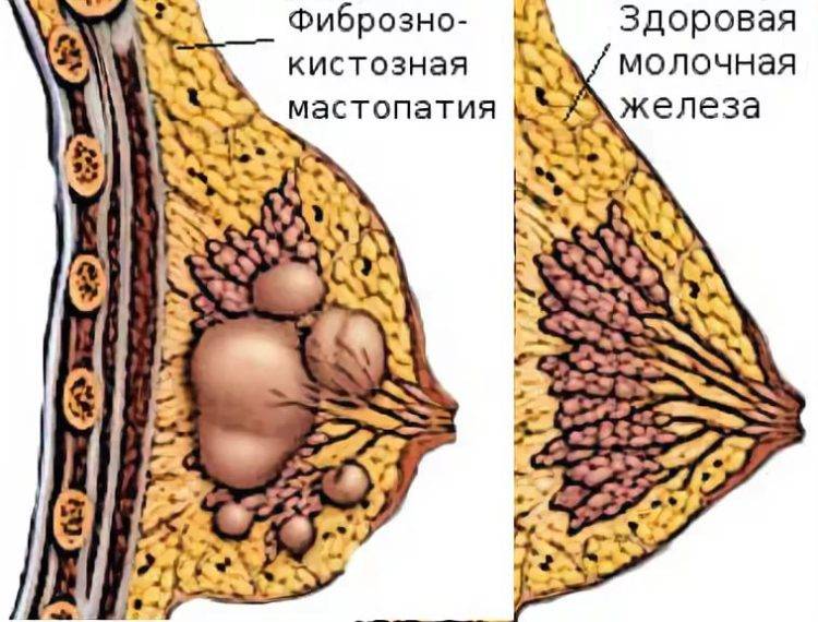 Галактоцеле — лактоцеле — кисты в молочной железе