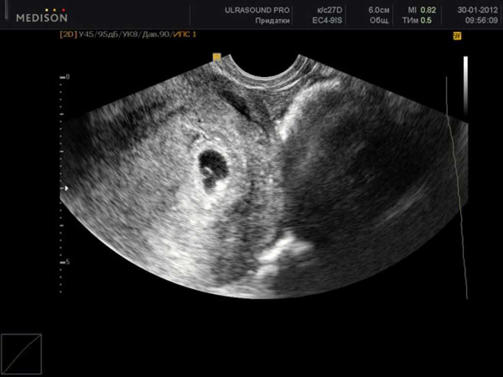 5 недель беременности описание и фото — евромедклиник 24