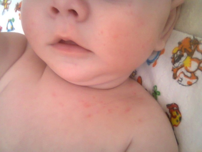 Красное пятно у ребенка на лице: причины и лечение