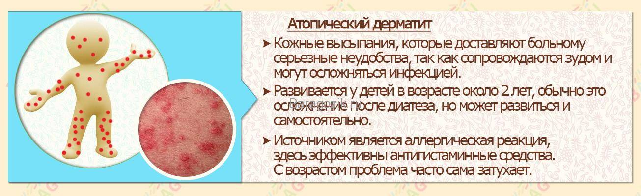Как лечить стафилококк у грудничка - советы от mums.ru