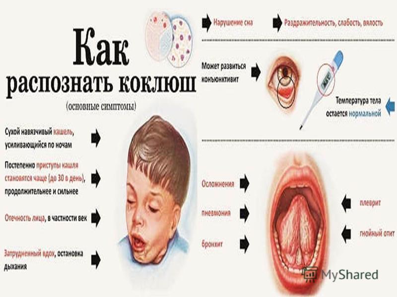 Коклюш у детей: что такое, причины, симптомы, лечение, профилактика, осложнения, средства