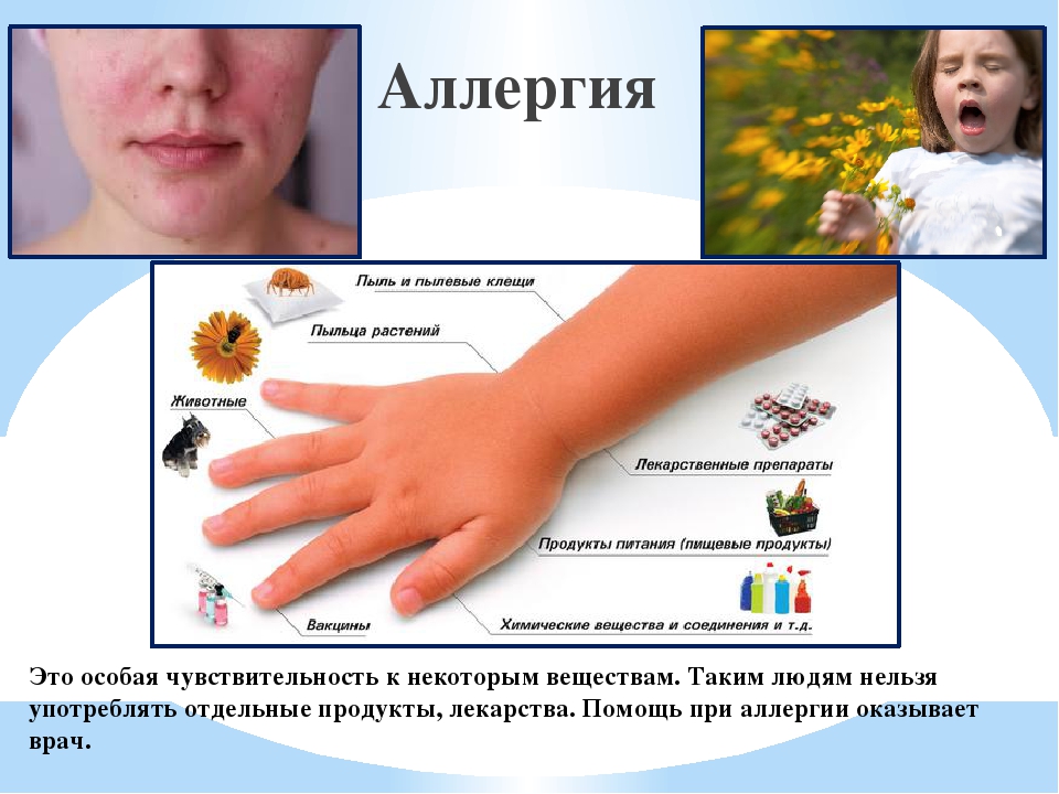 Аллергия на солнце у ребенка: симптомы, лечение, что делать