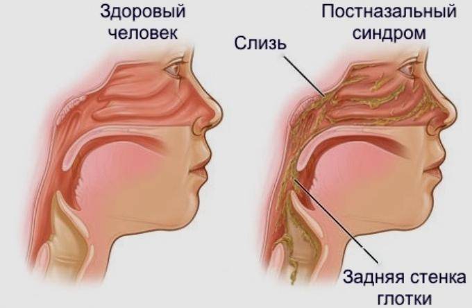 Причины и лечение насморка у новорожденных детей