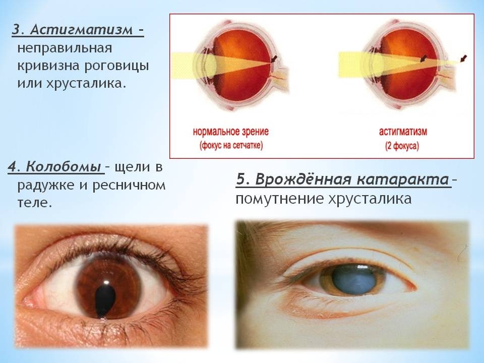Что после катаракты нельзя делать. Приосевой астигматизм. Острый миопический астигматизм. Врожденная болезнь глаз астигматизм. Миопический астигматизм слабой степени.