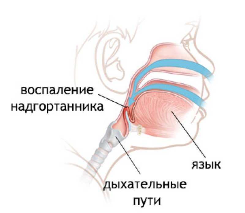 Эпиглоттит