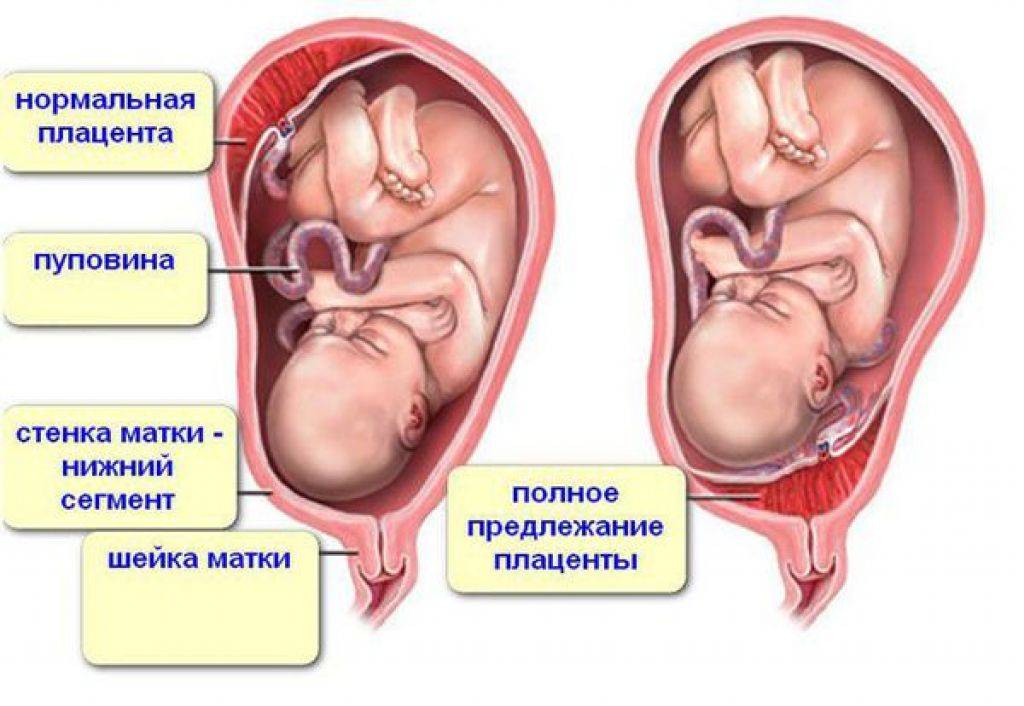 Низкая плацентация при беременности и предлежание: причины, что это, чем опасна