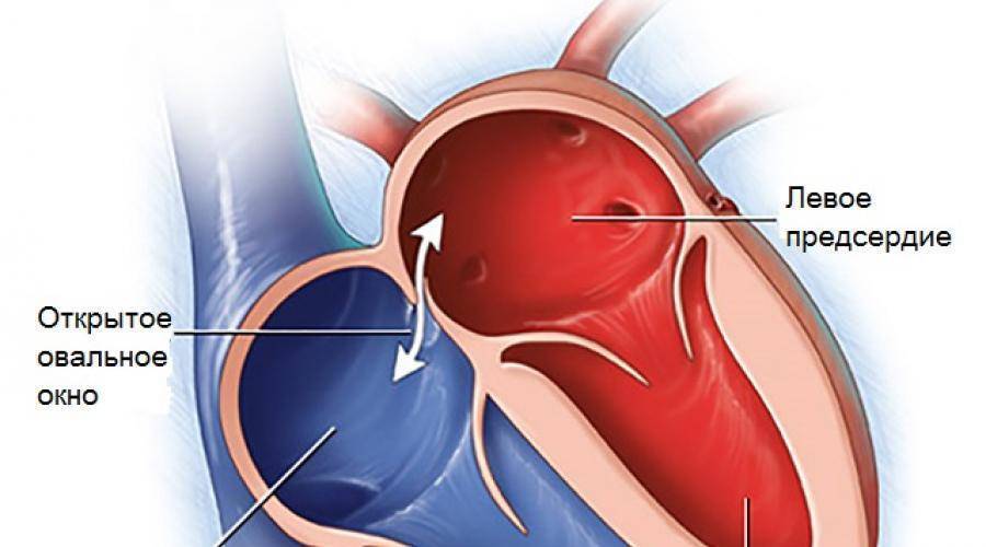 Открытое овальное окно в сердце у ребенка | prof-medstail.ru