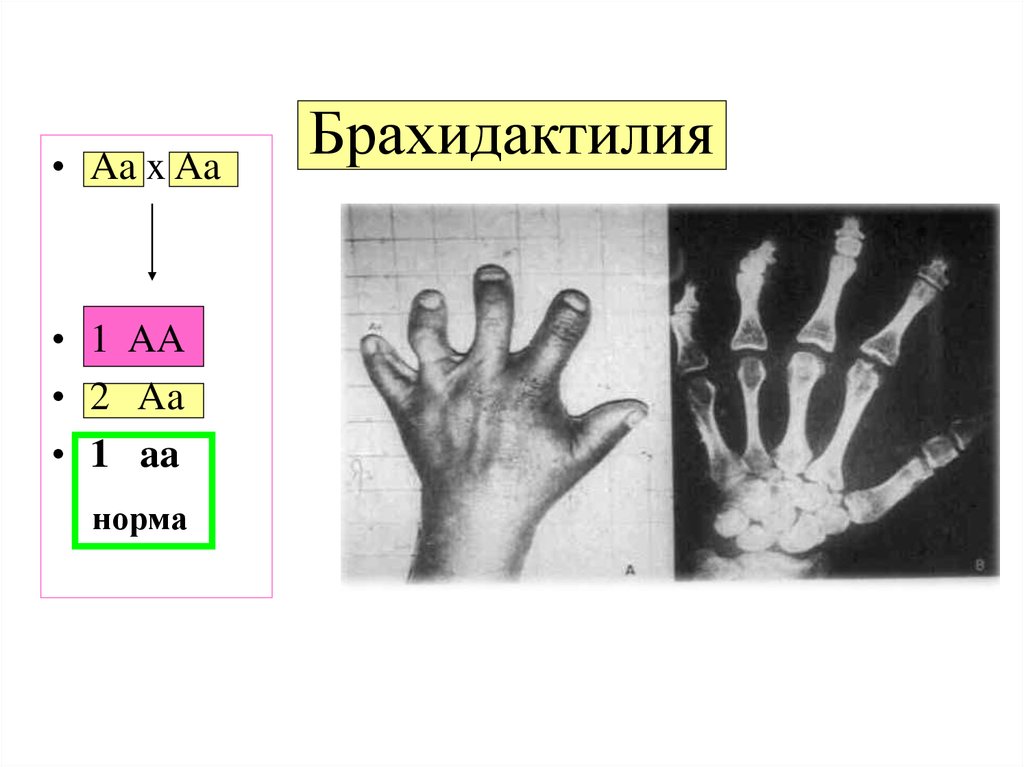 Генетика на пальцах. Брахидактилия наследуется. Брахидактилия Тип наследования. Наследование брахидактилии у человека.