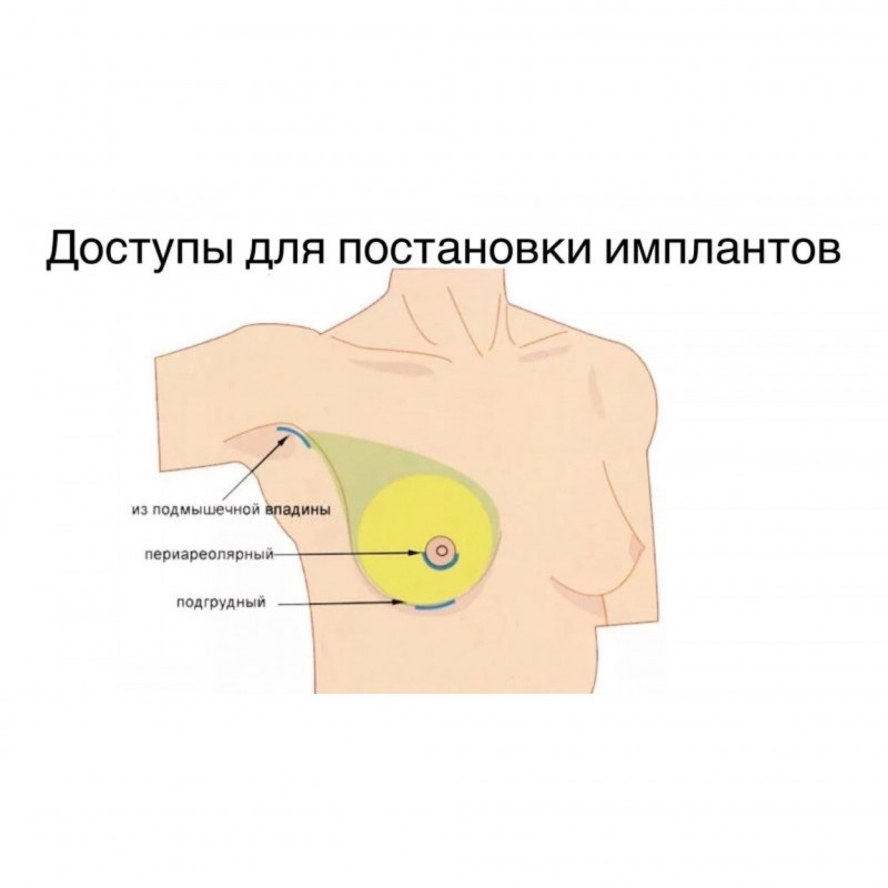 Можно ли кормить ребенка с силиконовыми имплантами?
