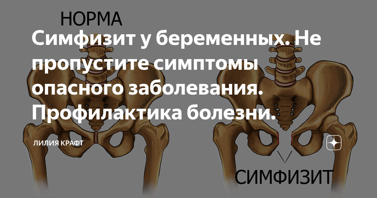 Симфизит при беременности что это симптомы. Симфизит. Симптомы симфизита. Симфизит при беременности.