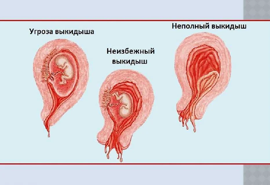 Выкидыш 16 Недель Фото