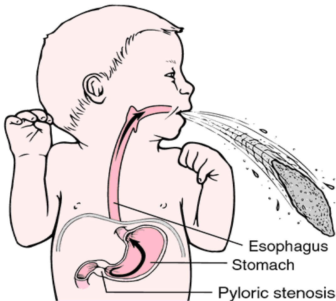 Срыгивание у грудничков: причины срыгивания и рвоты у новорожденных.