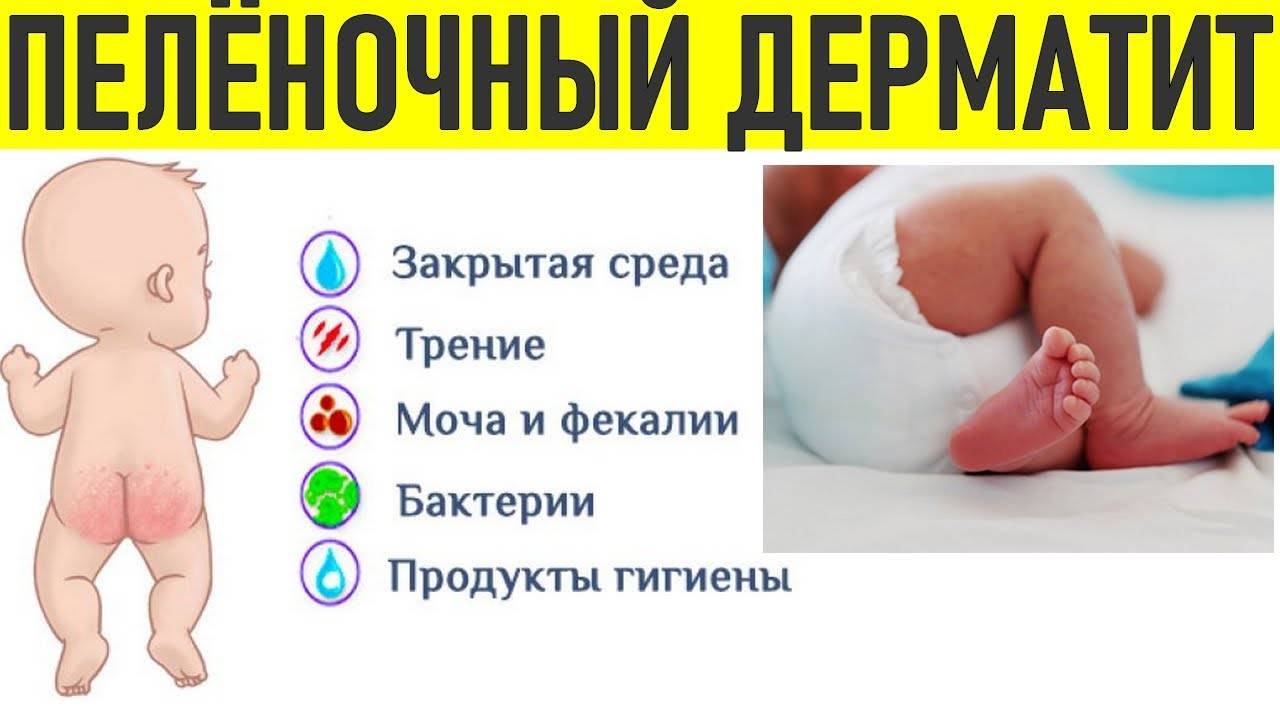 Пеленочный дерматит у детей, в том числе грибковый и памперсный: симптомы и лечение, фото