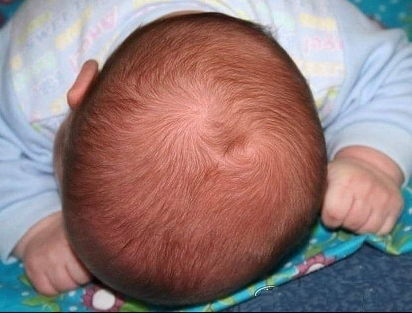 Почему появляется корочка на голове у ребенка 4-10 лет