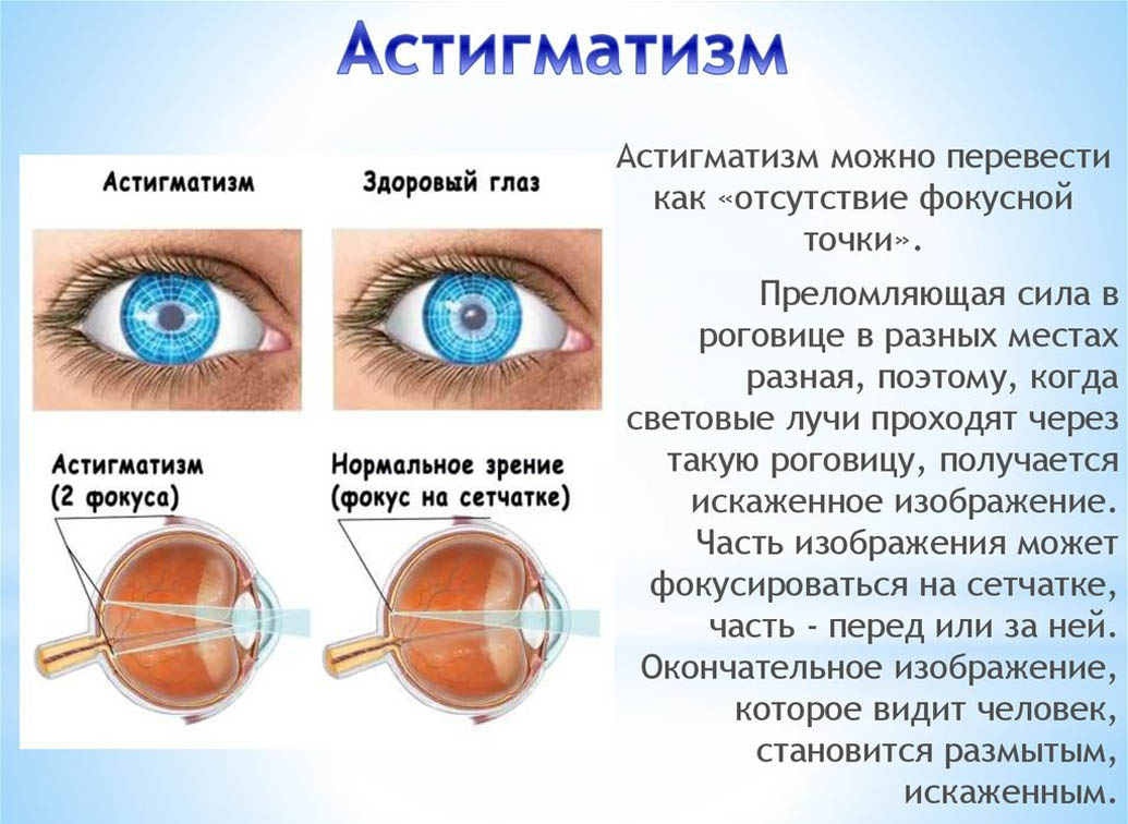 Астигматизм у детей и особенности его лечения