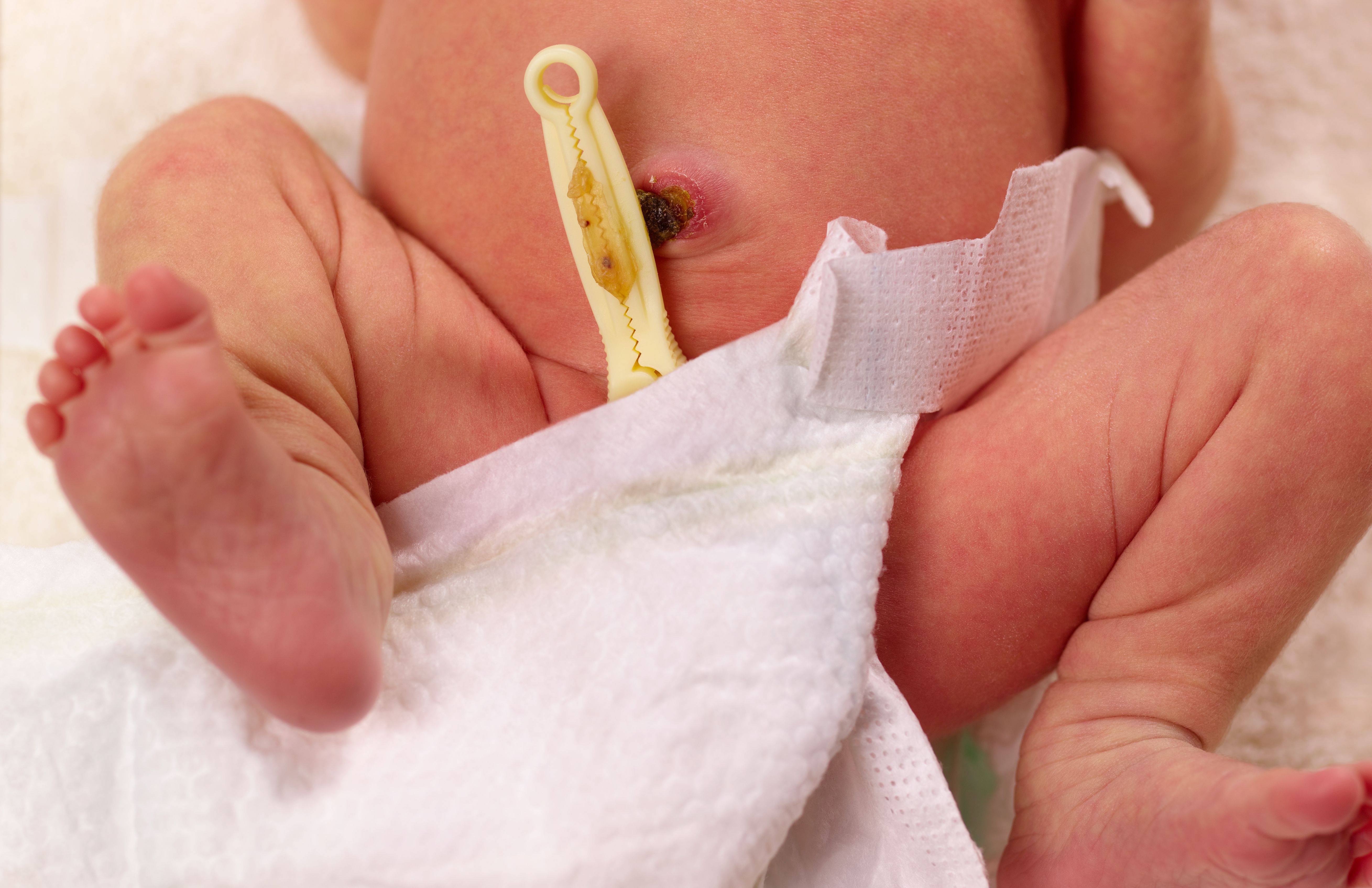 Как ухаживать и обрабатывать пупок новорождённого после прищепки