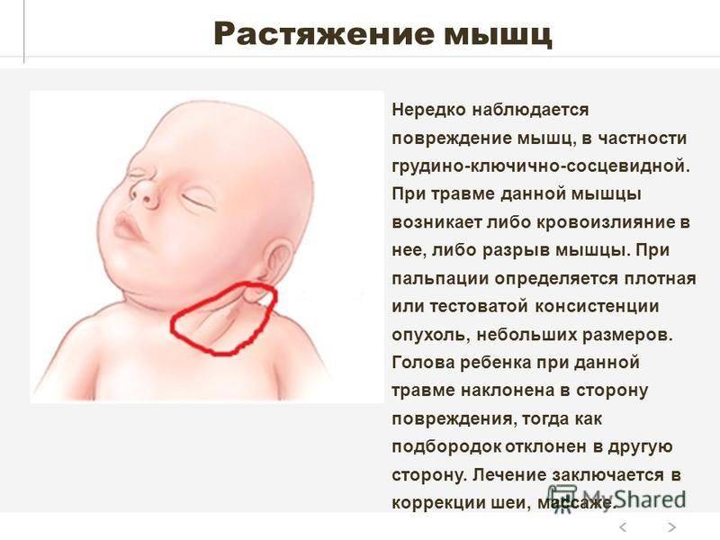 Синдром короткой шеи: что делать мамам грудничков?