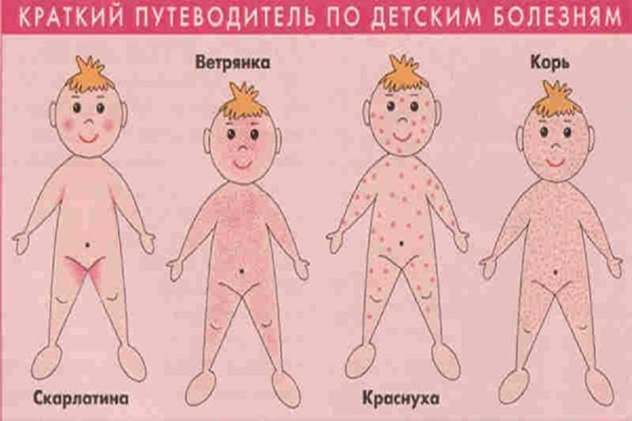 Краснуха у детей, взрослых и беременных женщин, руководство | разумный потребитель медицинских услуг