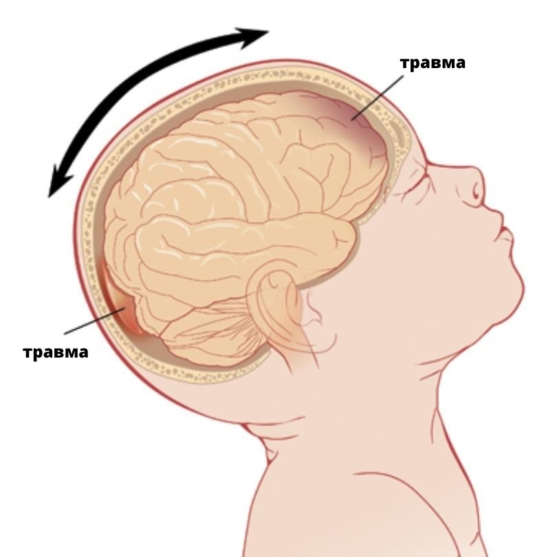 Признаки сотрясения мозга у ребенка от 1 года до 2, у младенцев и грудничков до 12 месяцев: симптомы, как определить и понять?