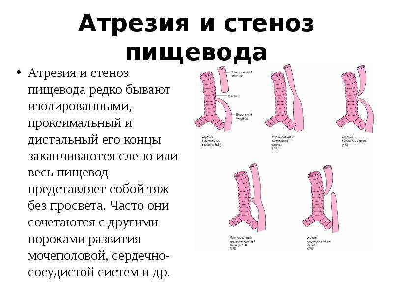 Атрезия пищевода — причины, симптомы и лечение