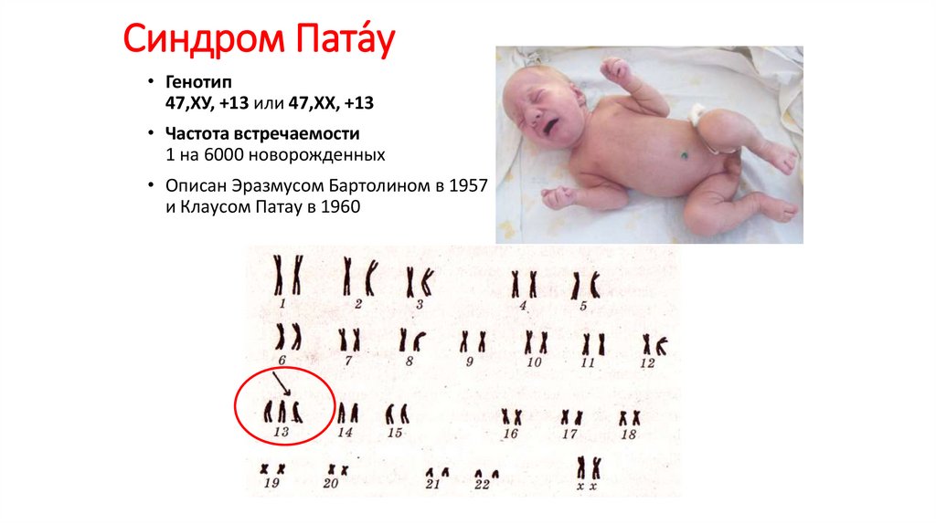 Синдром патау